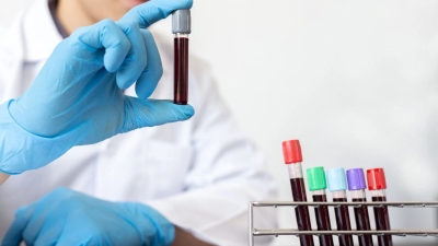 Анализ крови может стать маркером выживаемости при раке легких 