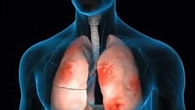 Ученые доказали уникальность нового лечения пневмонии с помощью оксида азота