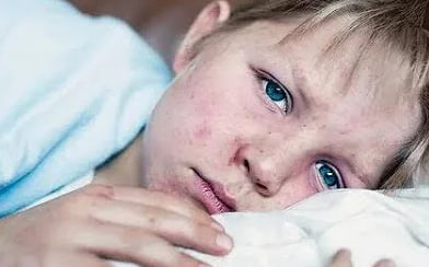 Заболеваемость корью и гриппом среди детей достигает критических значений в 2023 году