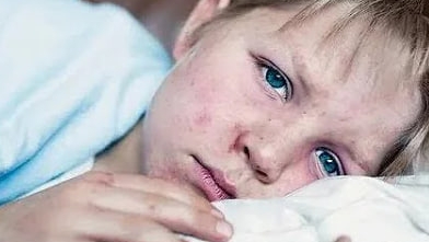 Заболеваемость корью и гриппом среди детей достигает критических значений в 2023 году