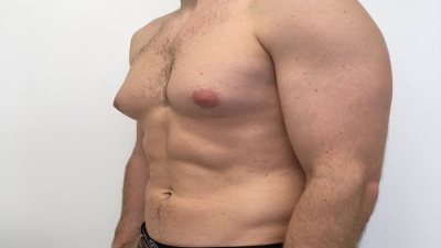 Риск преждевременной смерти выше среди мужчин с аномально большой грудью — ученые