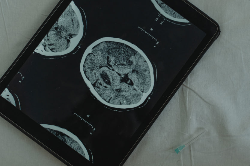 Нейрохирург Канаверо назвал «устаревшими» чипы для мозга от Илона Маска