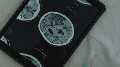 Нейрохирург Канаверо назвал «устаревшими» чипы для мозга от Илона Маска