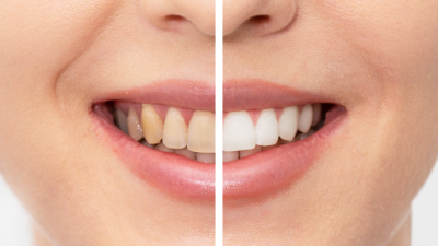 Секрет белой улыбки: 8 эффективных методов борьбы с желтыми зубами